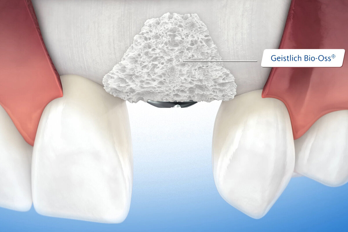 Восстановление костной ткани зубов. Искусственная кость в стоматологии. Наращивание костной ткани в стоматологии.