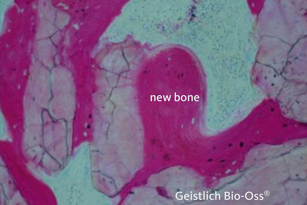 Geistlich Bio-Oss - Particles and new bone
